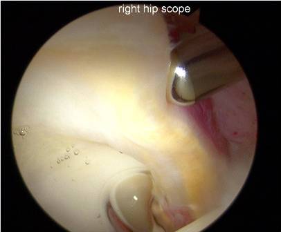 HipScope2